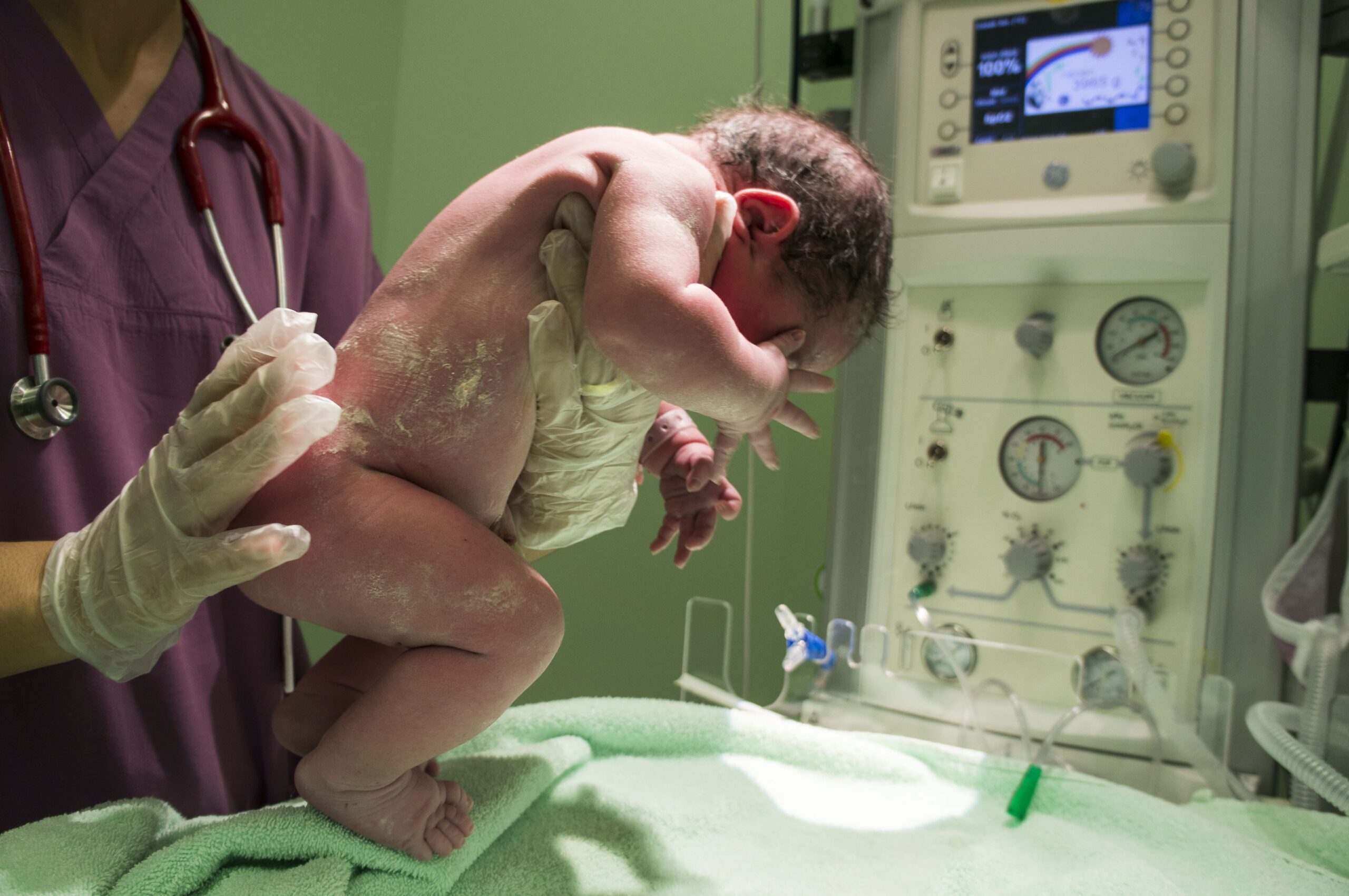 Illustration of forceps or vacuum extraction birth injury during delivery